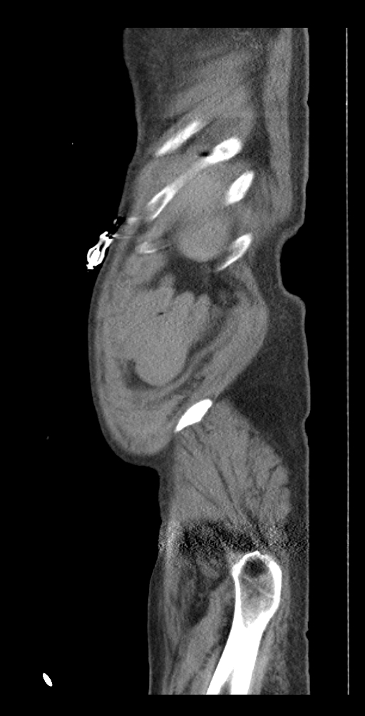 Aortoduodenal fistula (Radiopaedia 75286-86415 Sagittal C+ delayed 61).jpg