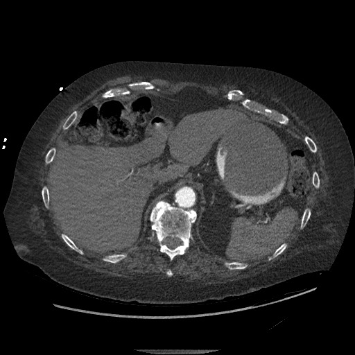 Aortoesophageal fistula with endovascular repair (Radiopaedia 73781-84592 Axial C+ CTPA 168).jpg