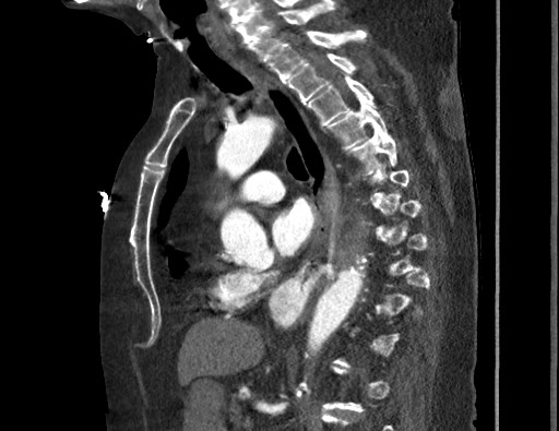 File:Aortoesophageal fistula with endovascular repair (Radiopaedia 73781-84592 Sagittal C+ CTPA 106).jpg