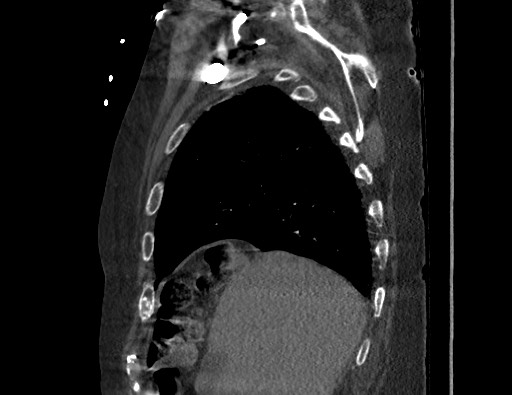 Aortoesophageal fistula with endovascular repair (Radiopaedia 73781-84592 Sagittal C+ CTPA 33).jpg