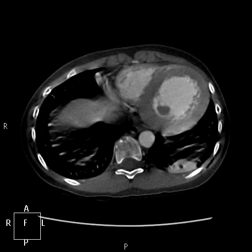 File:Aortopulmonary septal defect (Radiopaedia 41990-45013 Axial C+ CTPA 12).jpg