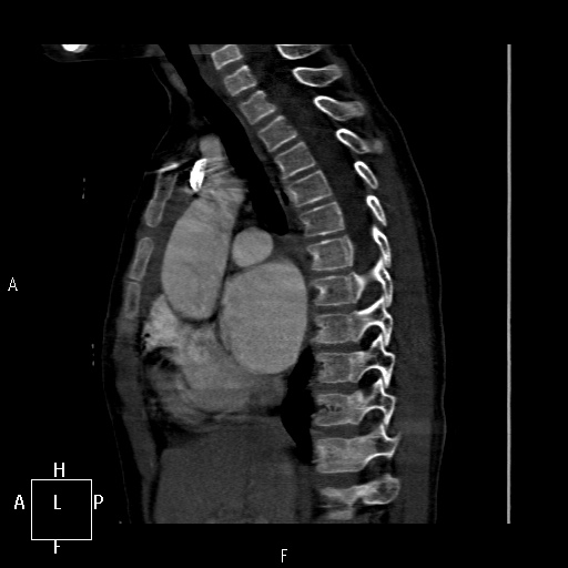 File:Aortopulmonary septal defect (Radiopaedia 41990-45013 Sagittal C+ CTPA 31).jpg