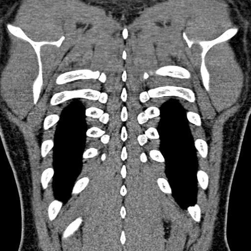 Apical lung mass mimic - neurogenic tumor (Radiopaedia 59918-67521 B 94).jpg