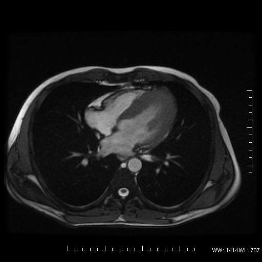 File:Apical non-obstructive hypertrophic cardiomyopathy (Yamaguchi hypertrophy) (Radiopaedia 16177).png