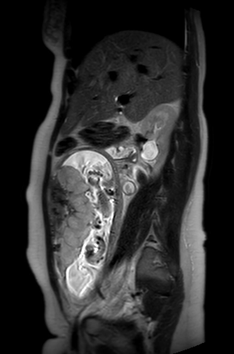 Appendicitis in gravida (MRI) (Radiopaedia 89433-106395 Sagittal T2 42).jpg
