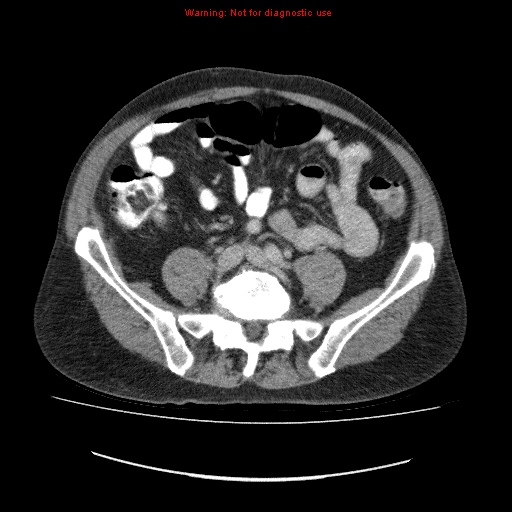 File:Appendicitis mass in inguinal hernia (Radiopaedia 26858-27029 A 3).jpg