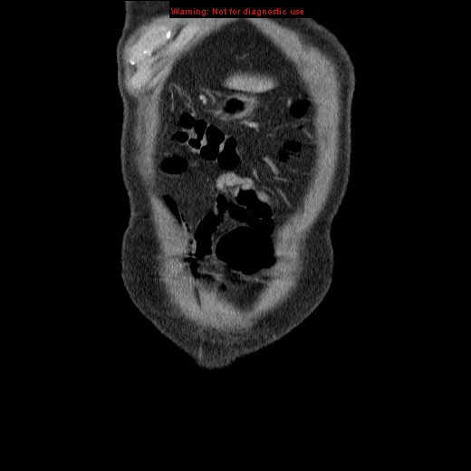 File:Appendicitis mass in inguinal hernia (Radiopaedia 26858-27029 B 1).jpg