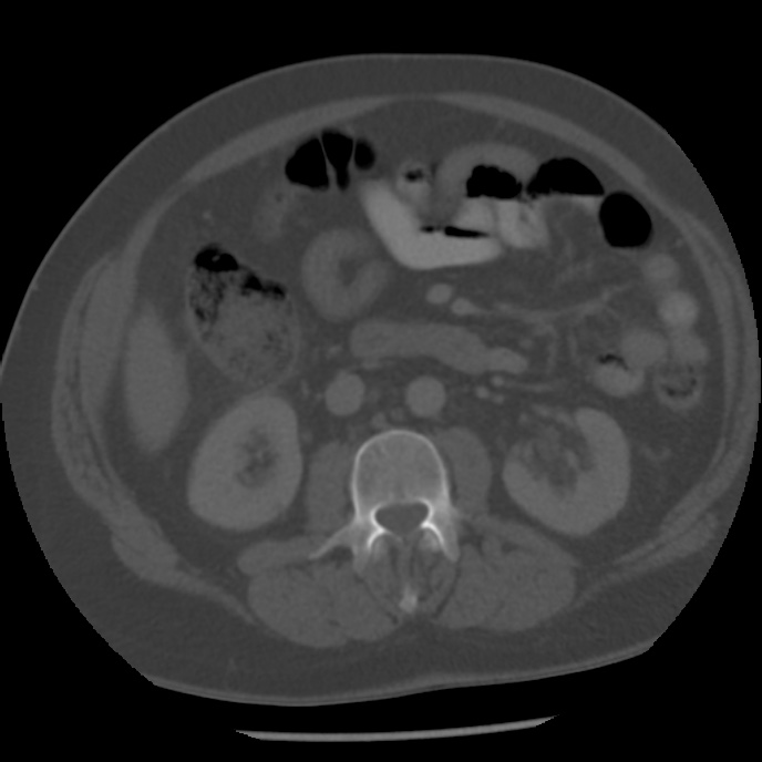 Appendicitis with perforation (Radiopaedia 35790-37342 Axial bone window 23).jpg