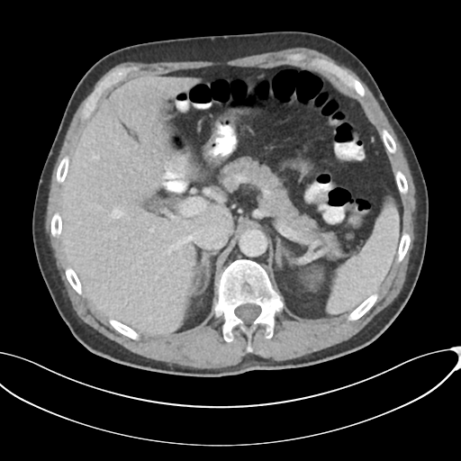 Appendicitis with thickening of the terminal ileum (Radiopaedia 42432-45550 A 26).png