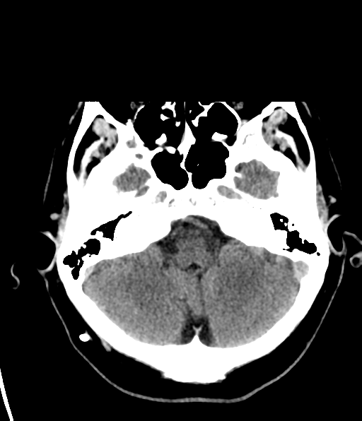 File:Aqueduct stenosis with corpus callosum hypoattenuation post shunting (Radiopaedia 37212-38973 Axial non-contrast 7).png