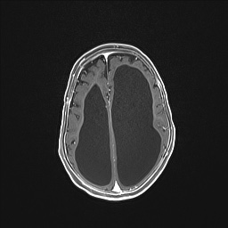Aqueductal stenosis (Radiopaedia 73974-84802 Axial T1 C+ 107).jpg