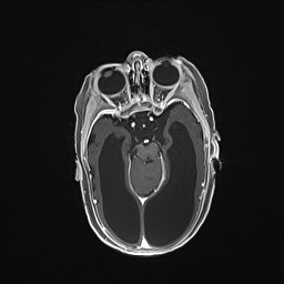 Aqueductal stenosis (Radiopaedia 73974-84802 Axial T1 C+ 66).jpg