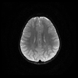 Arachnoid cyst - middle cranial fossa (Radiopaedia 86780-102938 Axial DWI 39).jpg