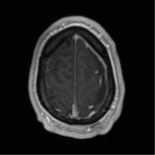 Arachnoid cyst with subdural hematoma (Radiopaedia 85892-101743 Axial T1 C+ 72).png