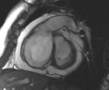 Arrhythmogenic right ventricular cardiomyopathy (Radiopaedia 69431-79307 Short axis cine 196).jpg