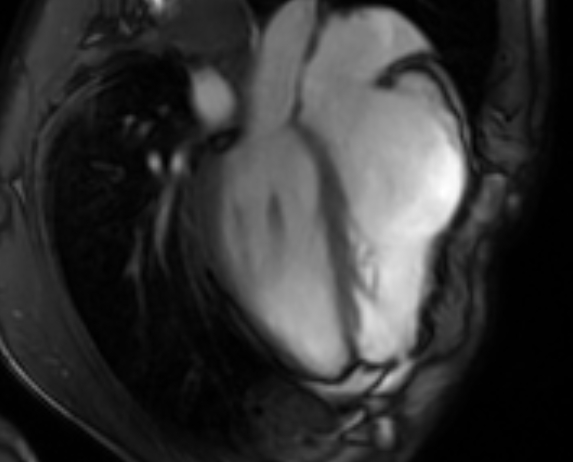 Arrhythmogenic right ventricular cardiomyopathy (Radiopaedia 69564-79464 4ch cine 82).jpg