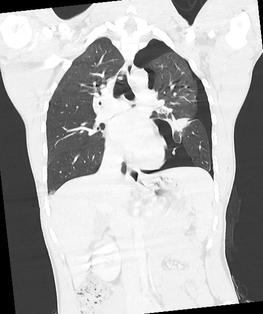 Arrow injury to the chest (Radiopaedia 85367-100975 Coronal lung window 76).jpg