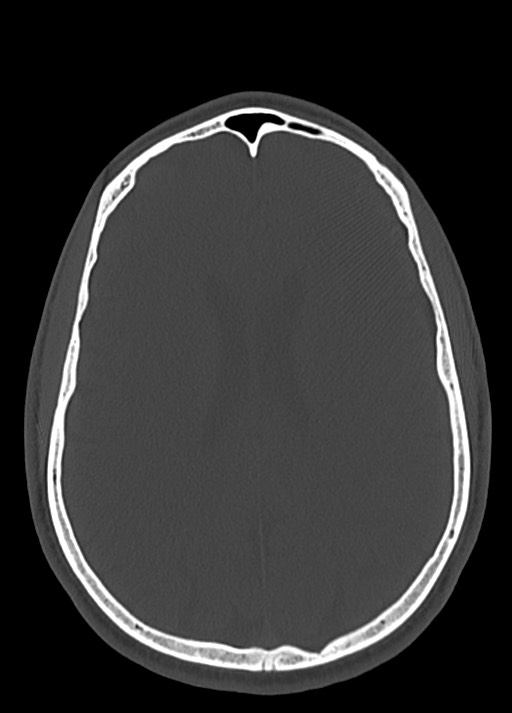 Arrow injury to the head (Radiopaedia 75266-86388 Axial bone window 83).jpg