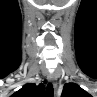 Arteriovenous malformation of the neck (Radiopaedia 53935-60062 D 15).jpg