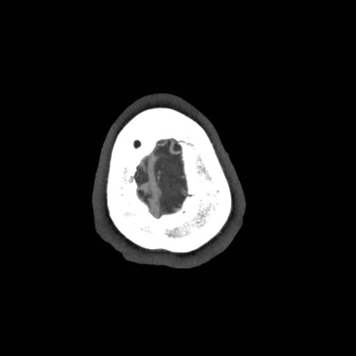 Artery of Percheron infarct (Radiopaedia 48088-52894 A 170).jpg