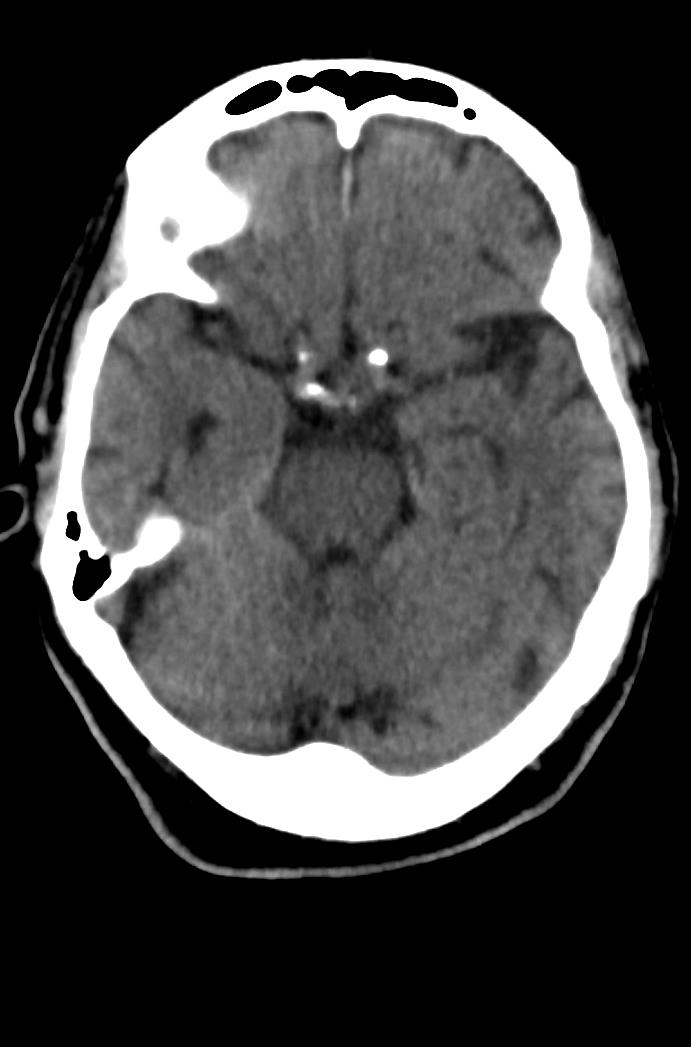 Artery of Percheron infarction (Radiopaedia 80613-94202 Axial non-contrast 70).jpg