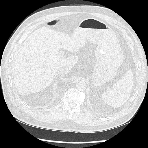 Asbestos-related pleural disease (Radiopaedia 74366-85250 Axial lung window 108).jpg