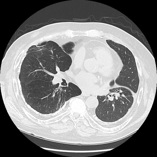 Asbestos-related pleural disease (Radiopaedia 74366-85250 Axial lung window 66).jpg