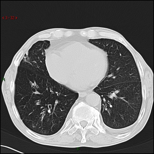 File:Aspergilloma (Radiopaedia 14842-14787 Axial lung window 32).jpg