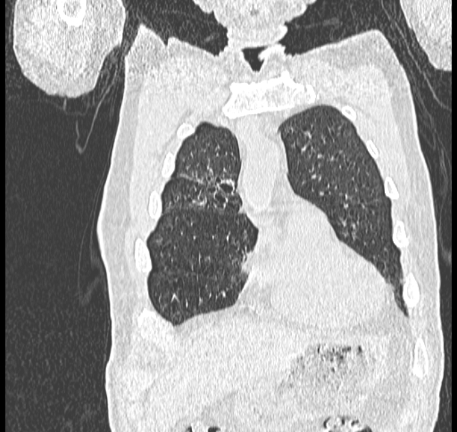 Aspergilloma (Radiopaedia 44592-48327 Coronal lung window 17).jpg