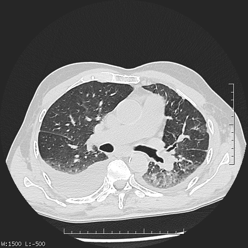 Aspergilloma (Radiopaedia 75184-86270 Axial lung window 23).jpg