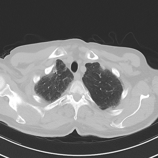 File:Aspergilloma on background pulmonary fibrosis (Radiopaedia 60942-68757 A 10).jpg