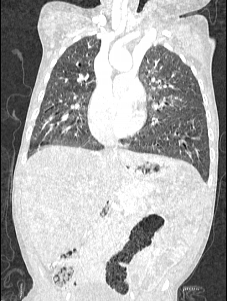 Asplenia syndrome (Radiopaedia 73083-83792 Coronal lung window 65).jpg