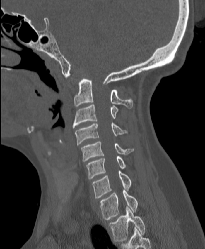 Atlanto-occipital assimilation with basilar invagination (Radiopaedia 70122-80188 Sagittal bone window 43).jpg