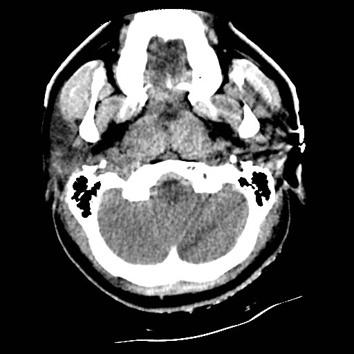Atlanto-occipital dislocation (Radiopaedia 44648-48412 Axial non-contrast 9).jpg