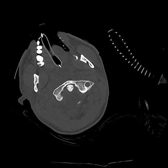 Atlanto-occipital dissociation (Traynelis type 1), C2 teardrop fracture, C6-7 facet joint dislocation (Radiopaedia 87655-104061 Axial bone window 20).jpg