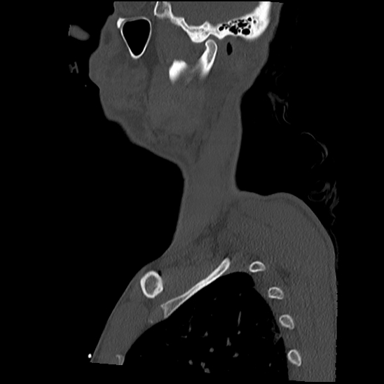 Atlanto-occipital dissociation (Traynelis type 1), C2 teardrop fracture, C6-7 facet joint dislocation (Radiopaedia 87655-104061 Sagittal bone window 6).jpg