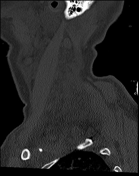 Atlanto-occipital dissociation - Traynelis type 1 (Radiopaedia 87570-103948 Sagittal bone window 72).jpg