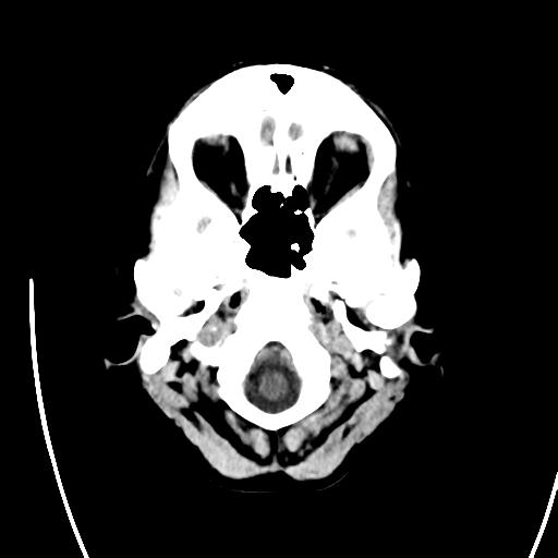 File:Atretic encephalocoele with inferior vermis hypoplasia (Radiopaedia 30443-31107 A 3).jpg