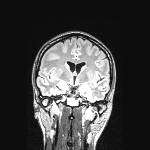 Atretic encephalocoele with inferior vermis hypoplasia (Radiopaedia 30443-31108 Coronal FLAIR 104).jpg