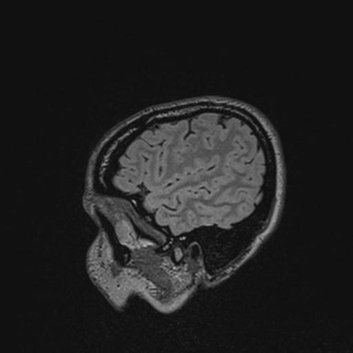 Atretic encephalocoele with inferior vermis hypoplasia (Radiopaedia 30443-31108 Sagittal FLAIR 33).jpg