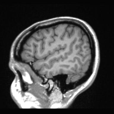 Atretic encephalocoele with inferior vermis hypoplasia (Radiopaedia 30443-31108 Sagittal T1 20).jpg