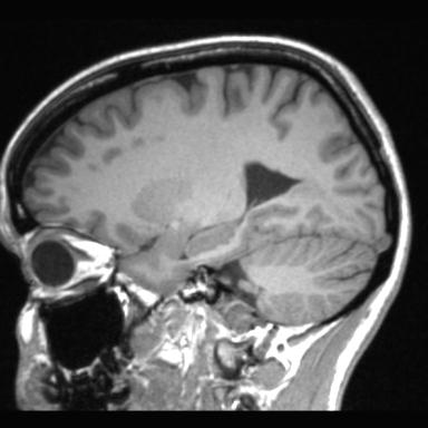 Atretic encephalocoele with inferior vermis hypoplasia (Radiopaedia 30443-31108 Sagittal T1 89).jpg