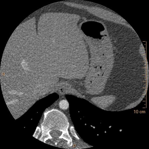 File:Atrial septal defect (upper sinus venosus type) with partial anomalous pulmonary venous return into superior vena cava (Radiopaedia 73228-83961 A 284).jpg