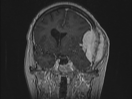 Atypical meningioma (Radiopaedia 62985-71406 Coronal T1 C+ 45).jpg