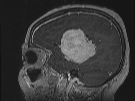 Atypical meningioma (Radiopaedia 62985-71406 Sagittal T1 C+ 71).jpg