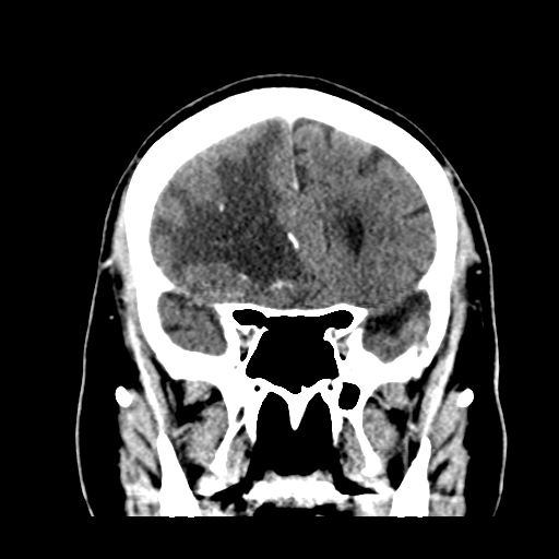 Atypical meningioma (WHO grade II) with brain invasion (Radiopaedia 57767-64728 Coronal C+ 21).png