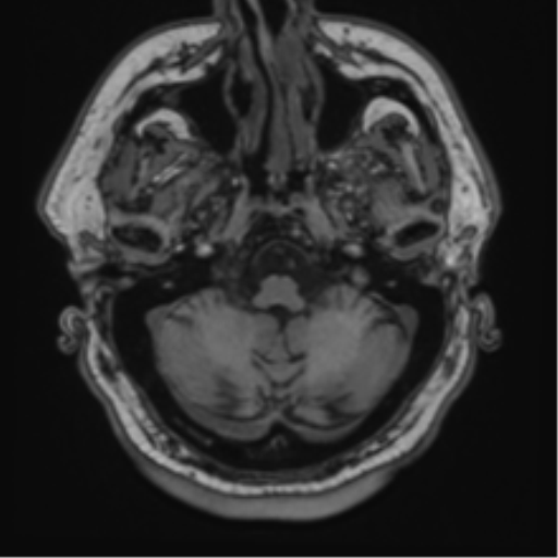 File:Atypical meningioma (WHO grade II) with brain invasion (Radiopaedia 57767-64729 Axial T1 8).png