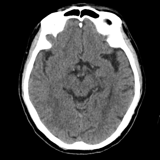 Atypical meningioma (WHO grade II) with osseous invasion (Radiopaedia 53654-59715 Axial non-contrast 24).png