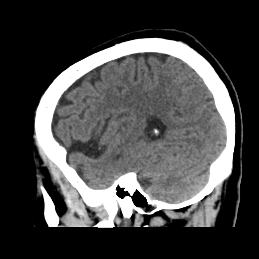 Atypical meningioma (WHO grade II) with osseous invasion (Radiopaedia 53654-59715 C 40).png