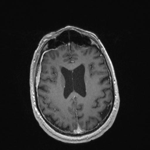 Atypical meningioma (grade II) - en plaque (Radiopaedia 29633-30147 Axial T1 C+ 125).jpg